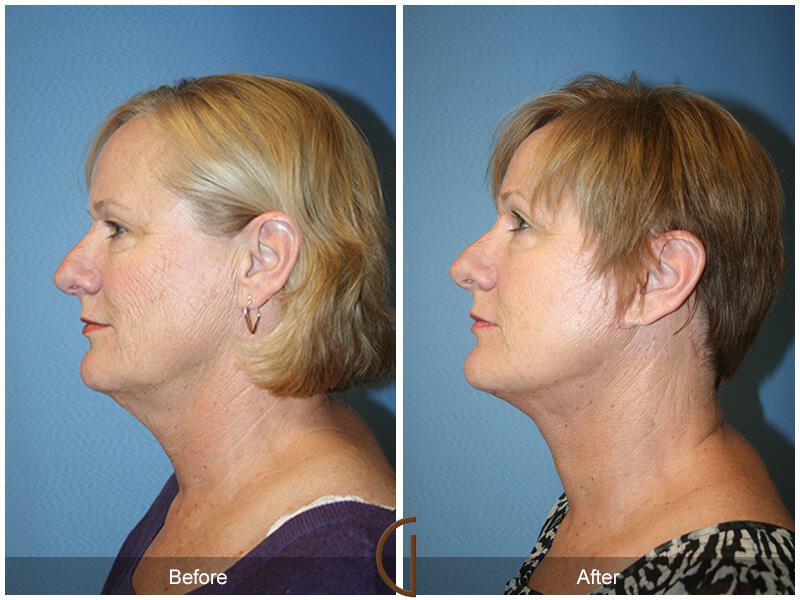 Facelift Fifties Before & After Photo