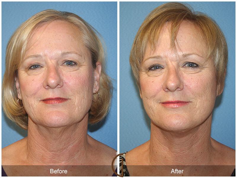 Facelift Fifties Before & After Photo