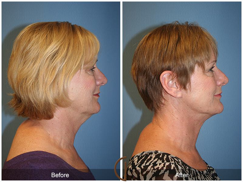 Facelift Fifties Before & After Photo