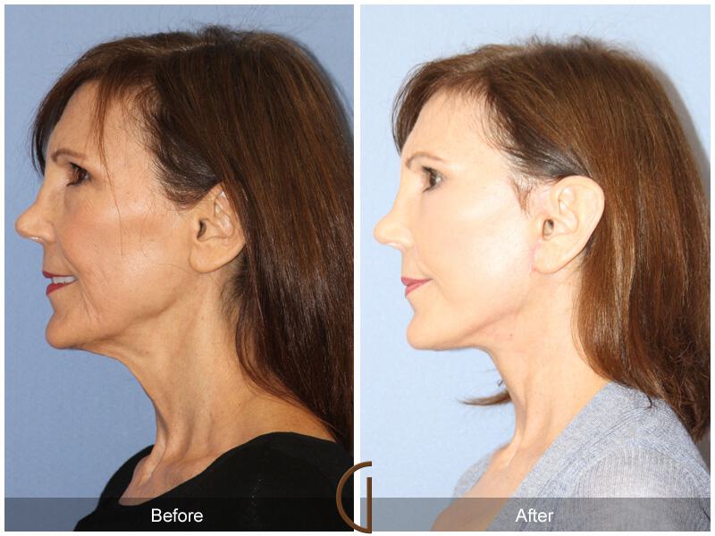 Facelift Fifties Before & After Photo