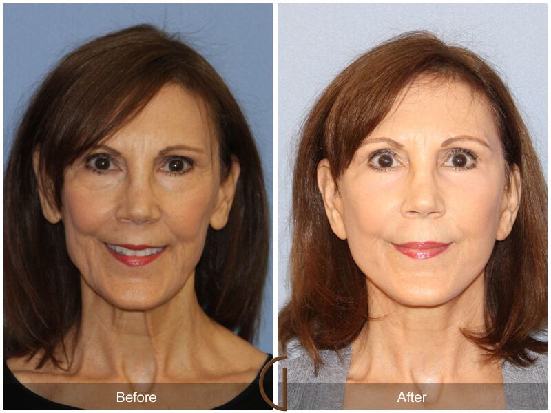 Facelift Fifties Before & After Photo