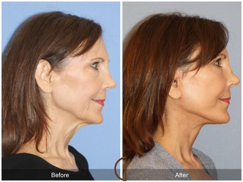 Facelift Fifties Before & After Photo