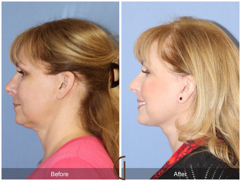 Facelift Fifties Before & After Photo