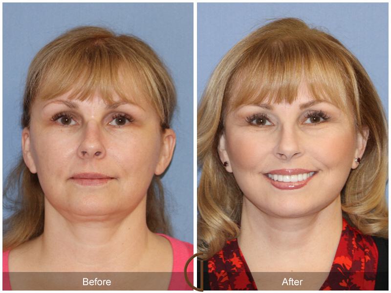 Facelift Fifties Before & After Photo