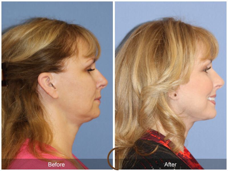 Facelift Fifties Before & After Photo