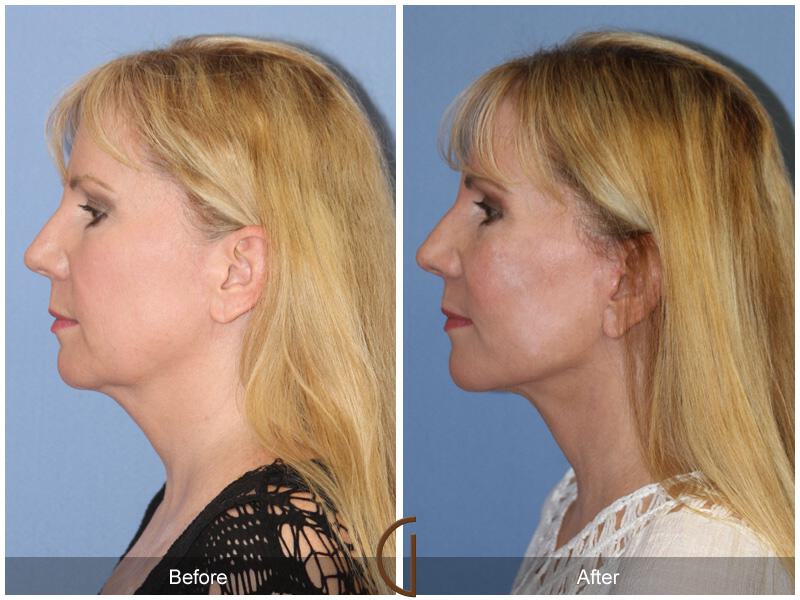 Facelift Fifties Before & After Photo