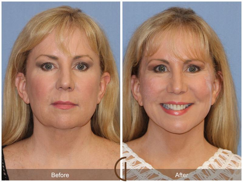 Facelift Fifties Before & After Photo