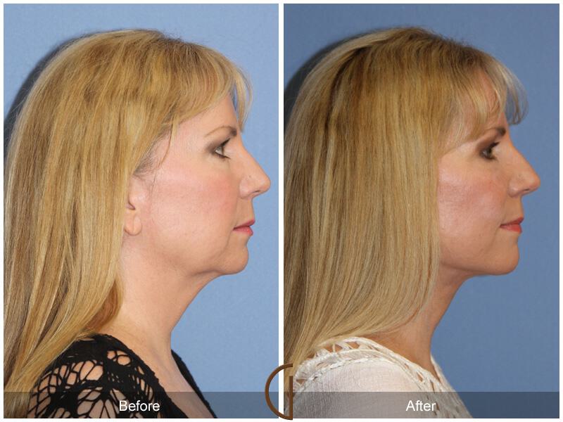 Facelift Fifties Before & After Photo