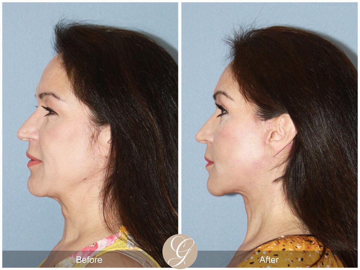 Facelift Fifties Before & After Photo