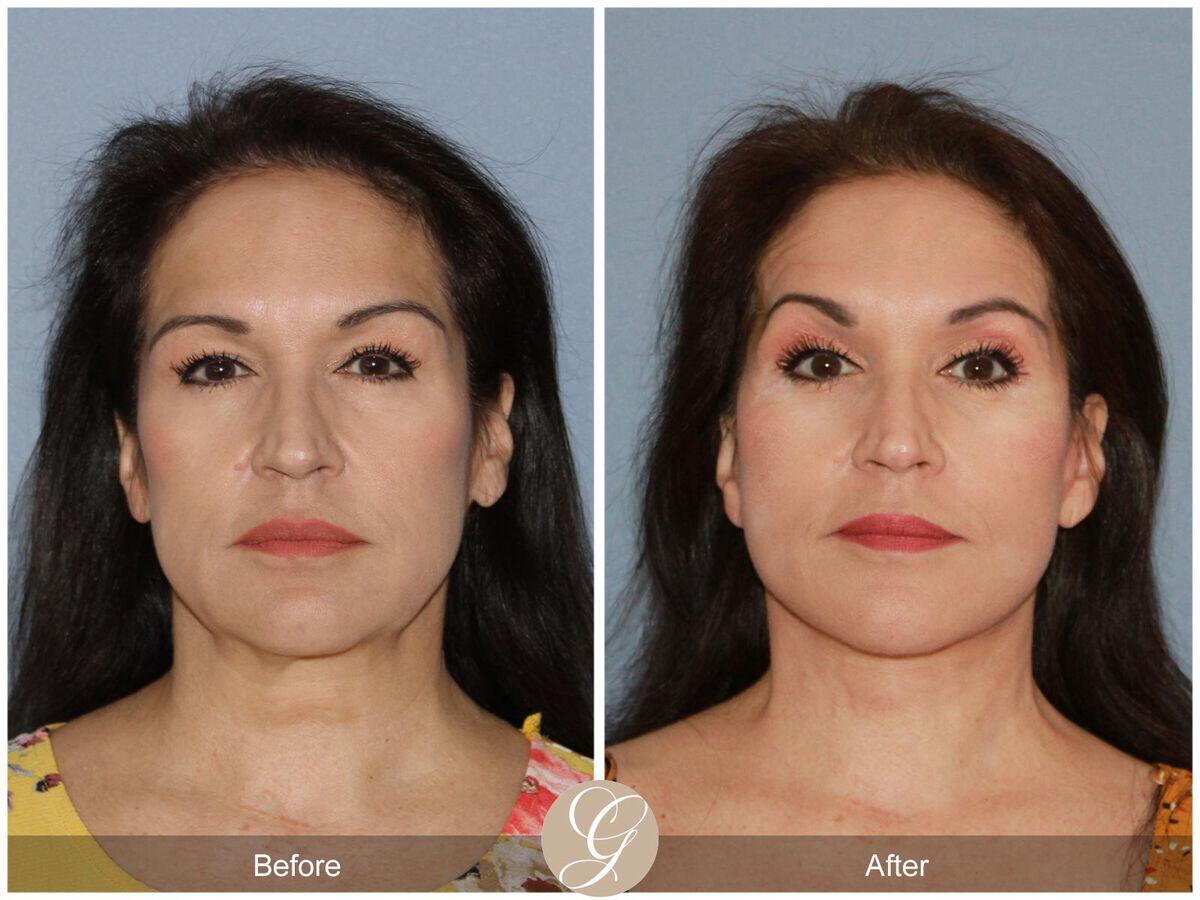 Facelift Fifties Before & After Photo