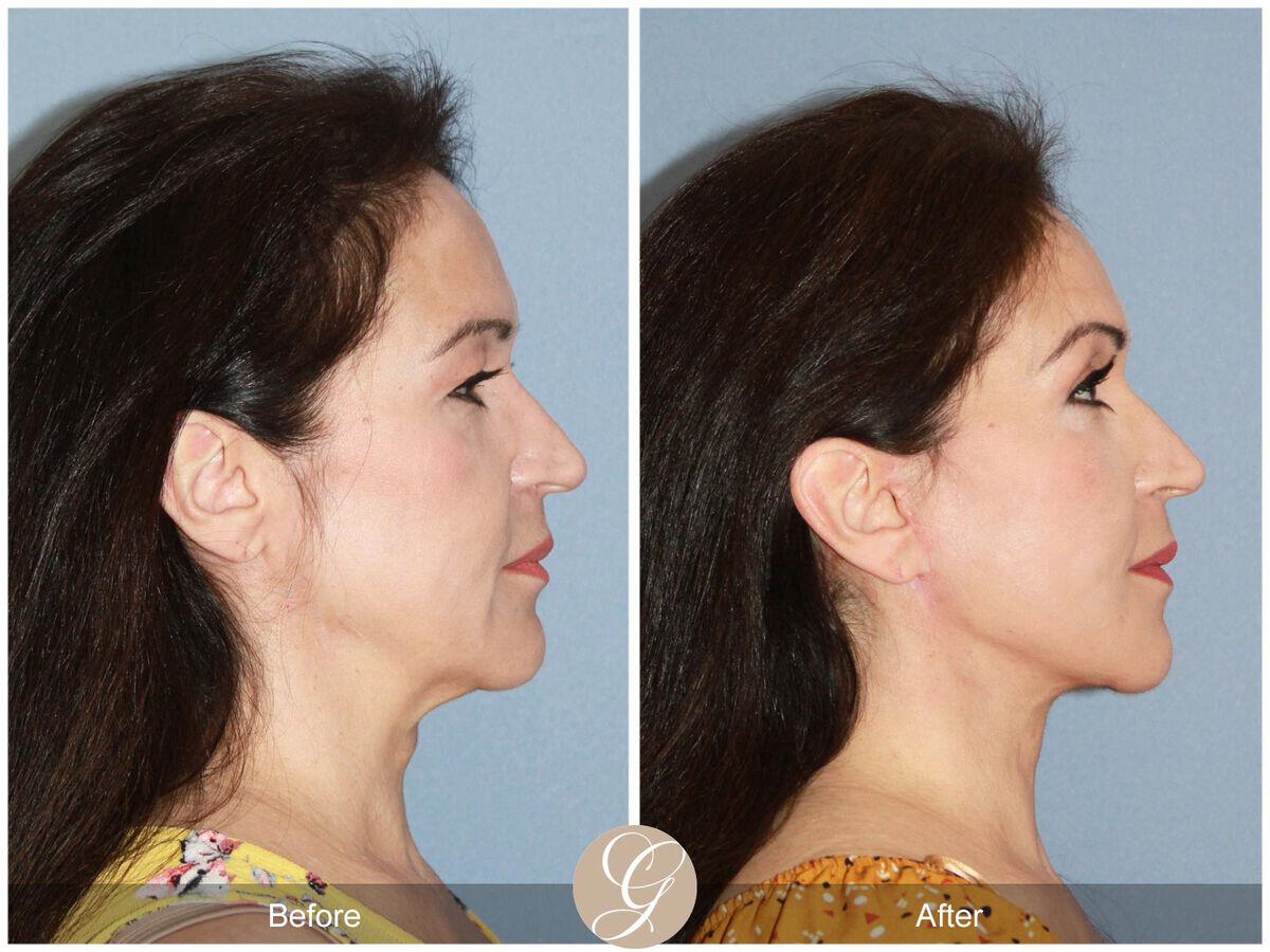 Facelift Fifties Before & After Photo