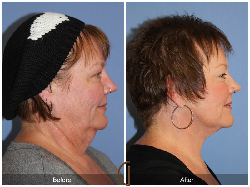 Facelift Fifties Before & After Photo