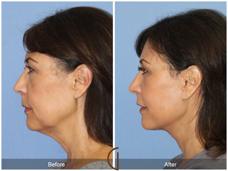 Facelift Fifties Before & After Photo