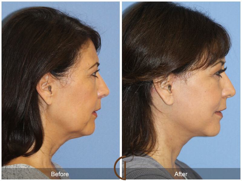 Facelift Fifties Before & After Photo