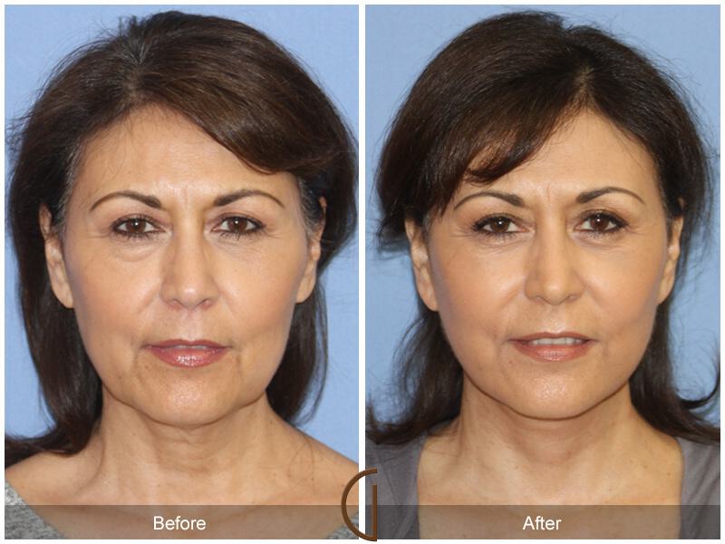 Facelift Fifties Before & After Photo