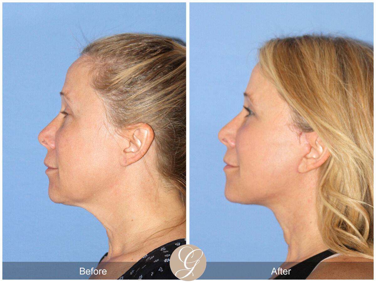 Facelift Fifties Before & After Photo