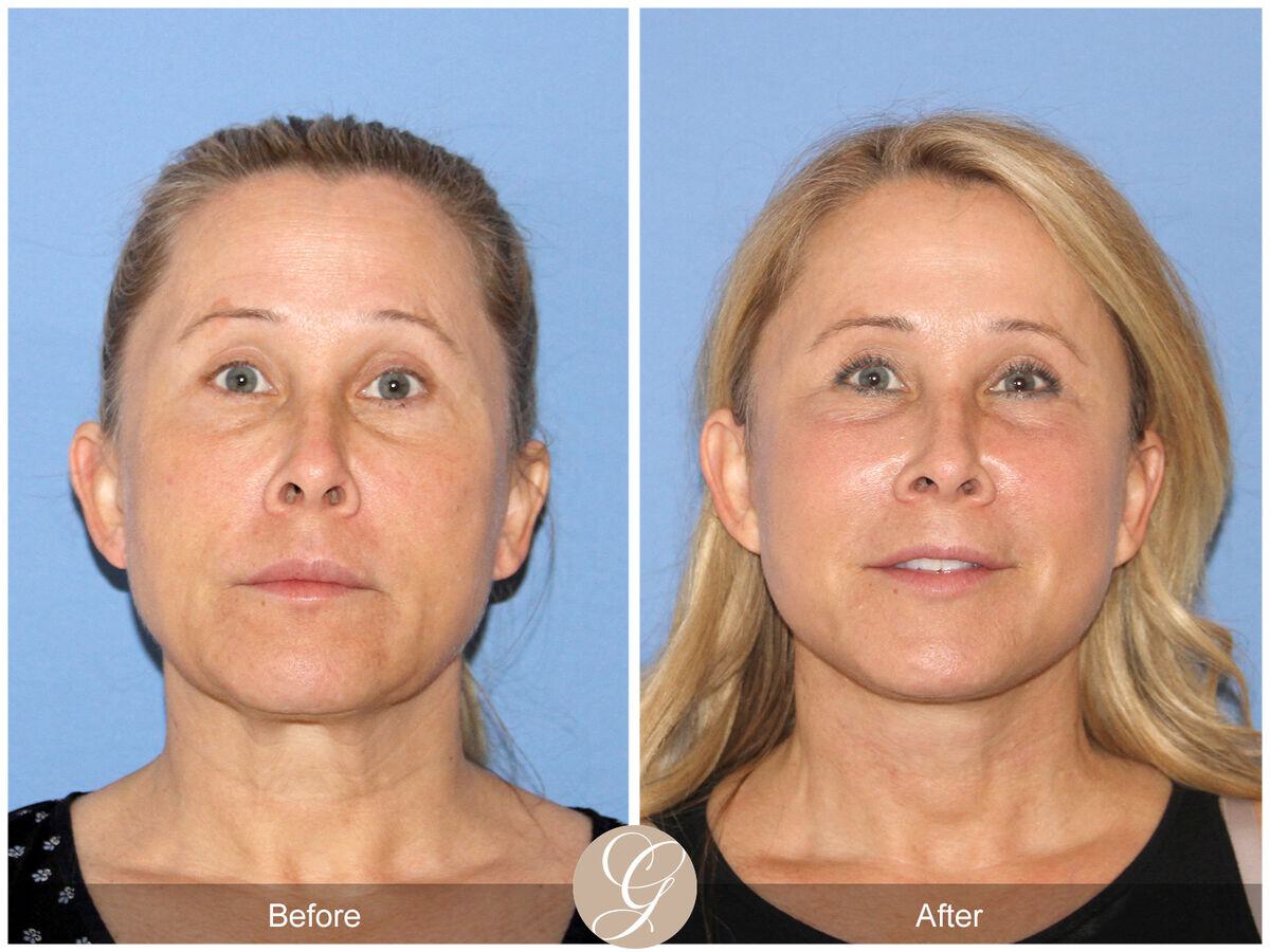 Facelift Fifties Before & After Photo