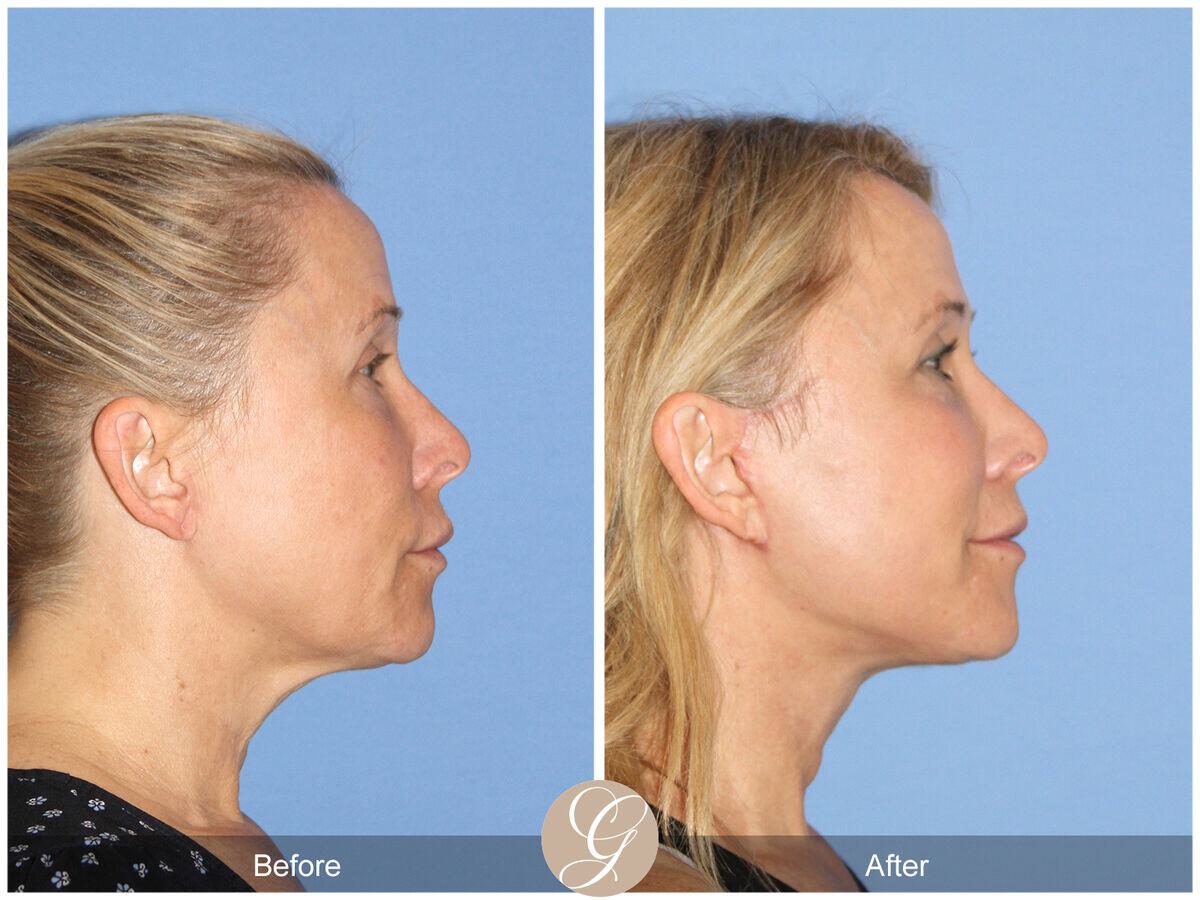 Facelift Fifties Before & After Photo