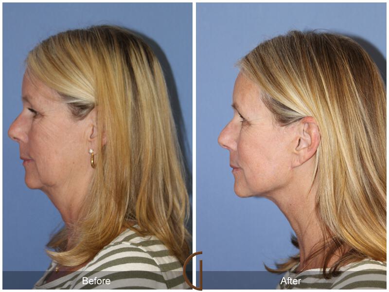 Facelift Fifties Before & After Photo