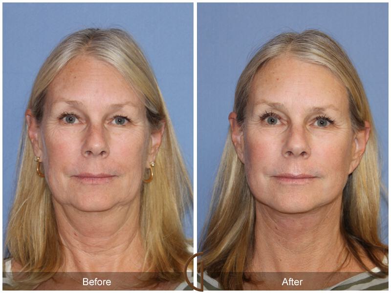 Facelift Fifties Before & After Photo