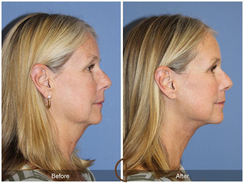 Facelift Fifties Before & After Photo