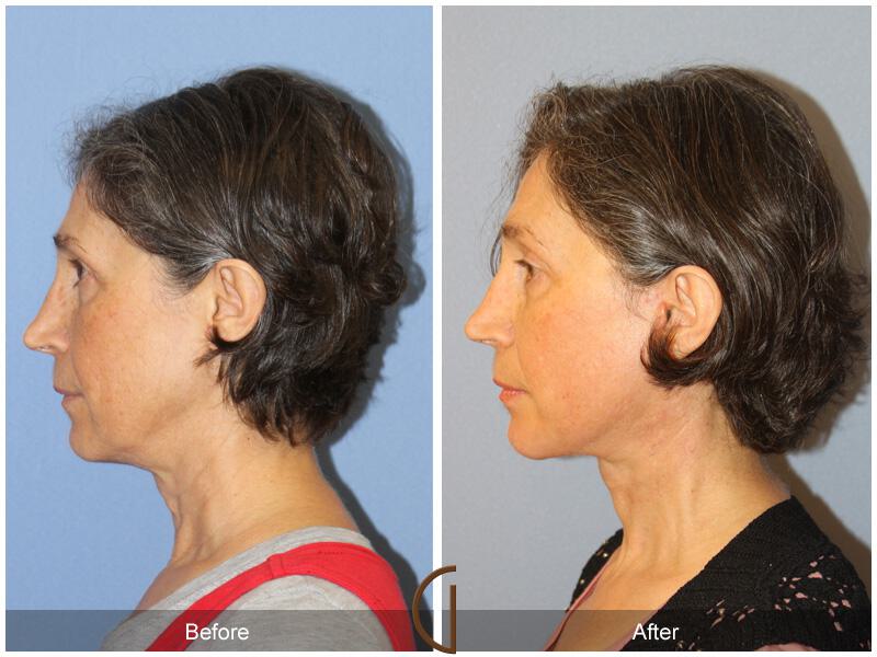 Facelift Fifties Before & After Photo