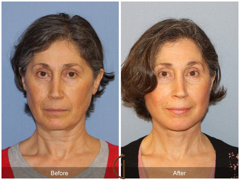 Facelift Fifties Before & After Photo