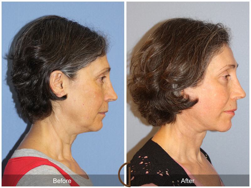 Facelift Fifties Before & After Photo