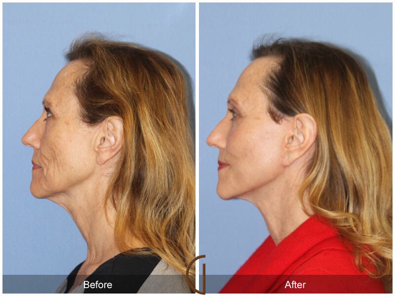 Facelift Fifties Before & After Photo