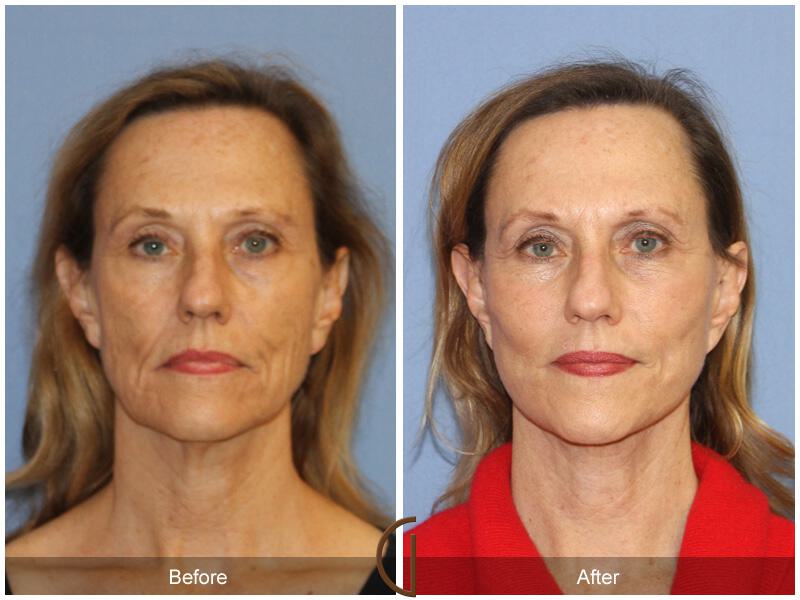 Facelift Fifties Before & After Photo