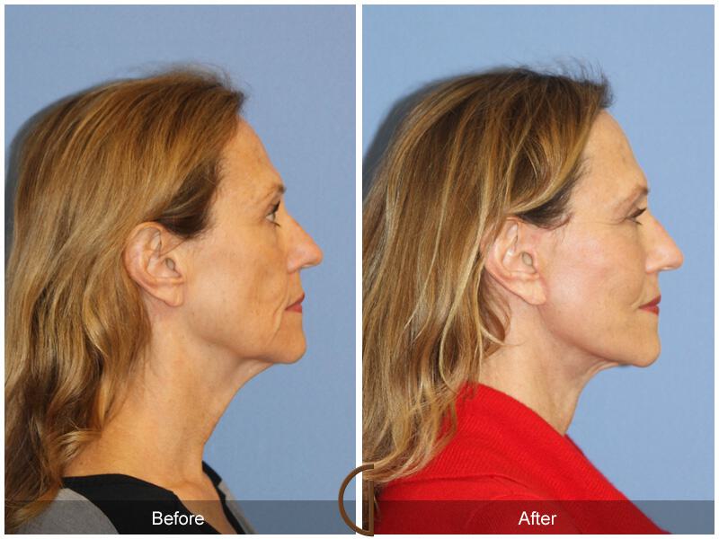 Facelift Fifties Before & After Photo