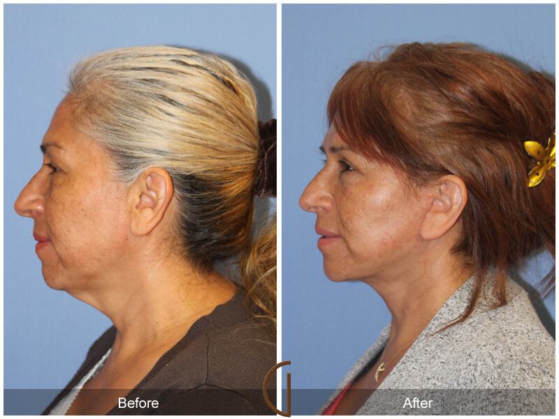 Facelift Fifties Before & After Photo