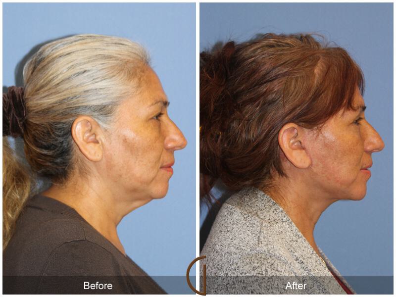 Facelift Fifties Before & After Photo