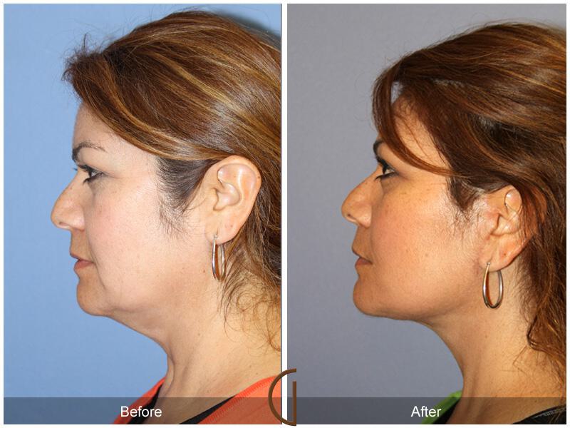 Facelift Fifties Before & After Photo