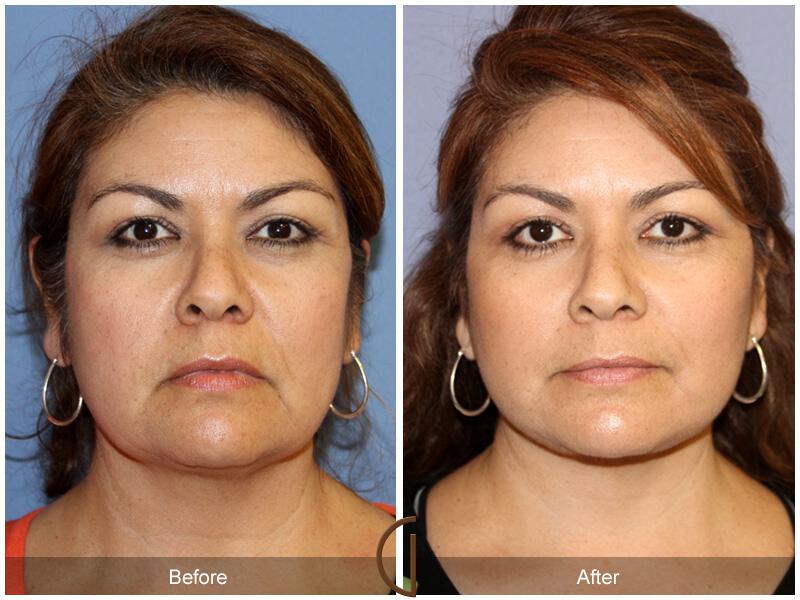 Facelift Fifties Before & After Photo