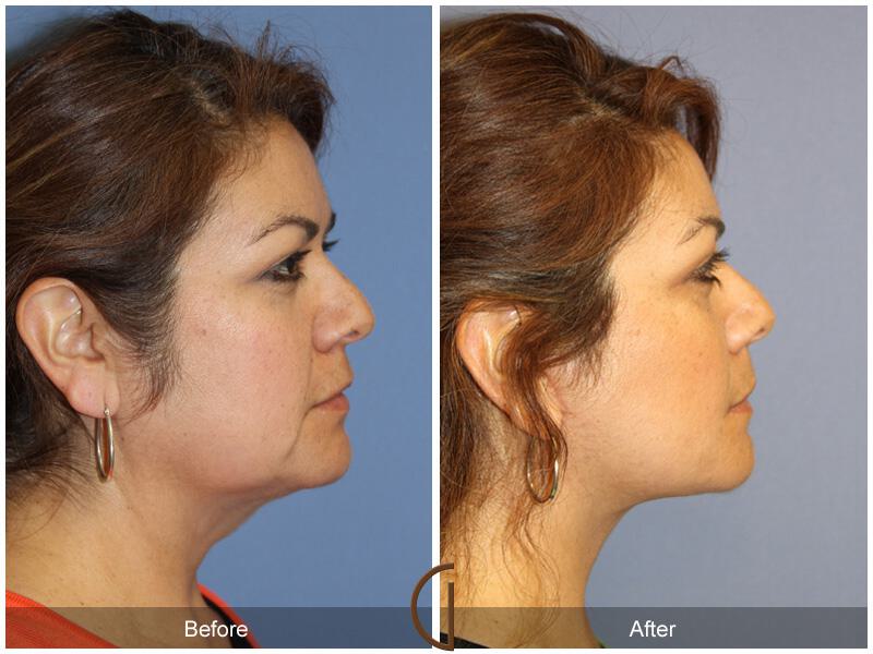 Facelift Fifties Before & After Photo