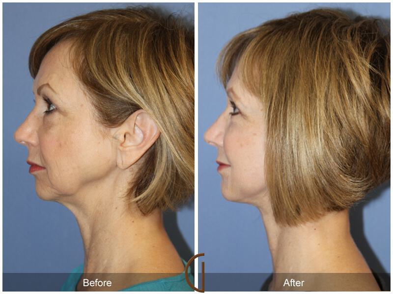 Facelift Fifties Before & After Photo