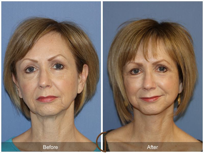 Facelift Fifties Before & After Photo