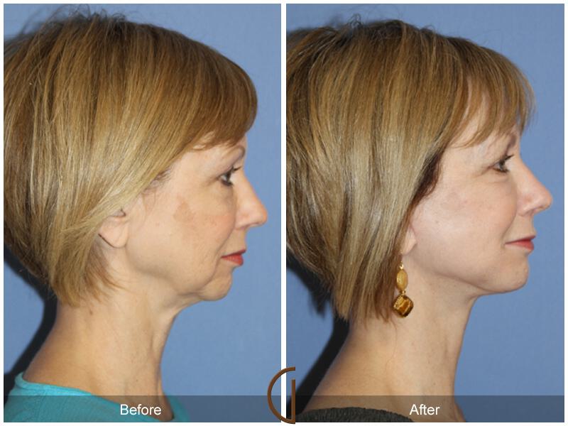 Facelift Fifties Before & After Photo