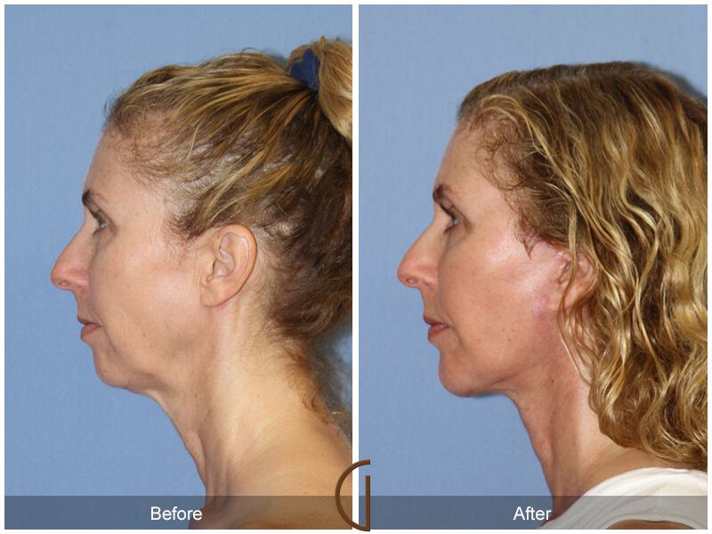 Facelift Fifties Before & After Photo