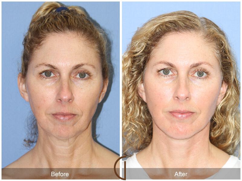 Facelift Fifties Before & After Photo