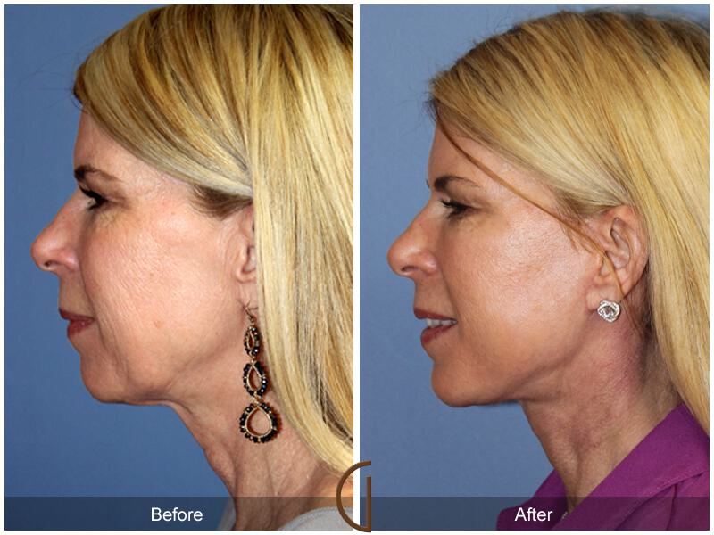 Facelift Fifties Before & After Photo