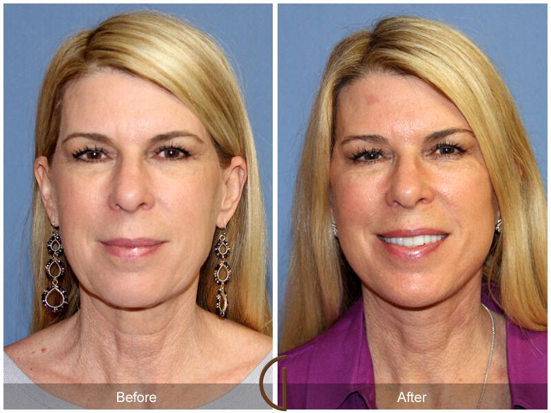 Facelift Fifties Before & After Photo