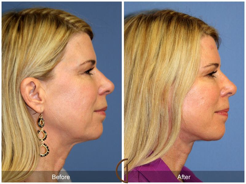 Facelift Fifties Before & After Photo