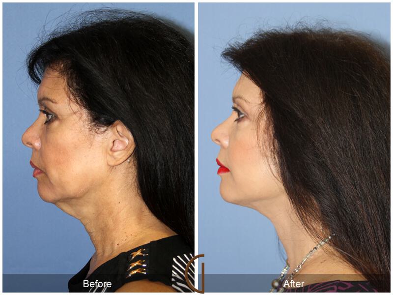 Facelift Fifties Before & After Photo