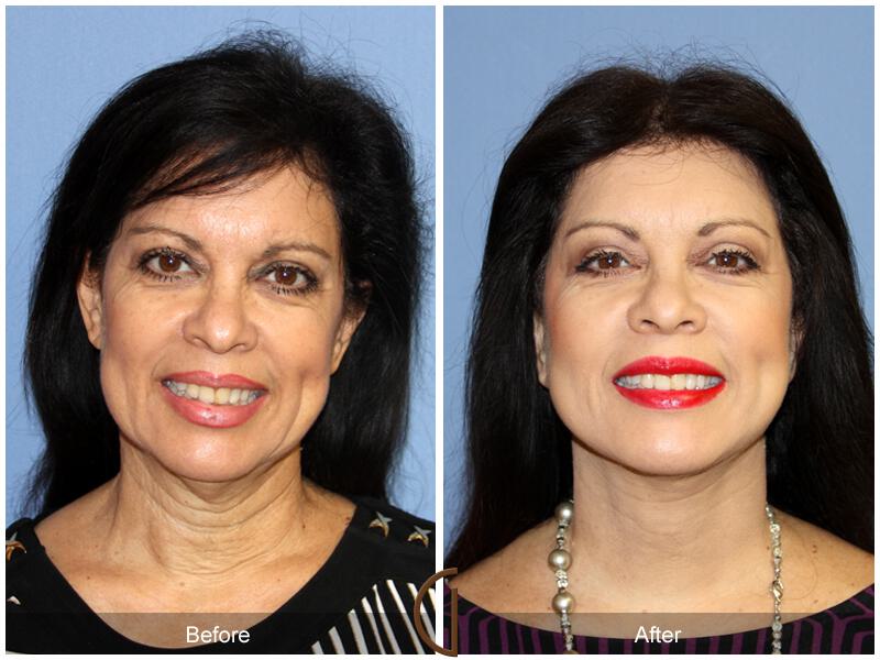 Facelift Fifties Before & After Photo