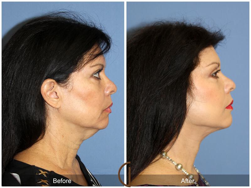 Facelift Fifties Before & After Photo