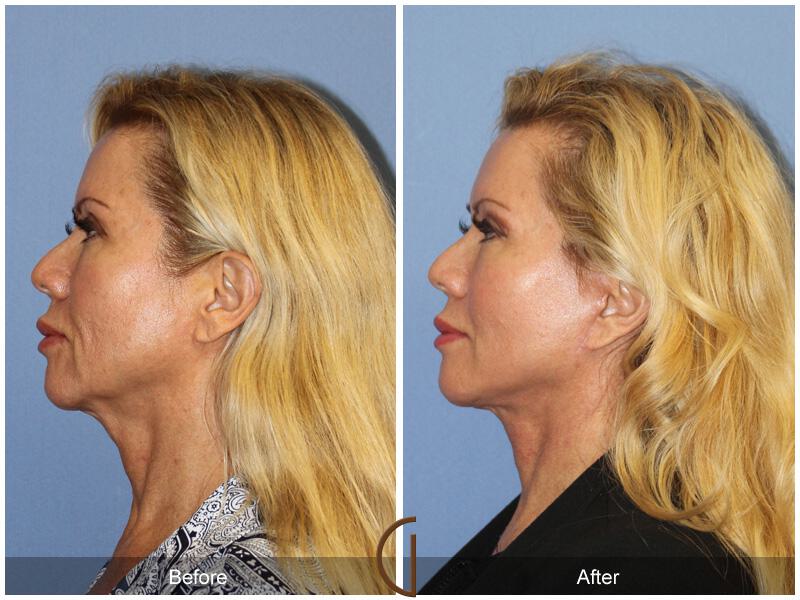 Facelift Fifties Before & After Photo