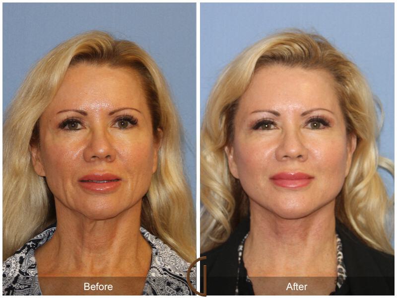 Facelift Fifties Before & After Photo