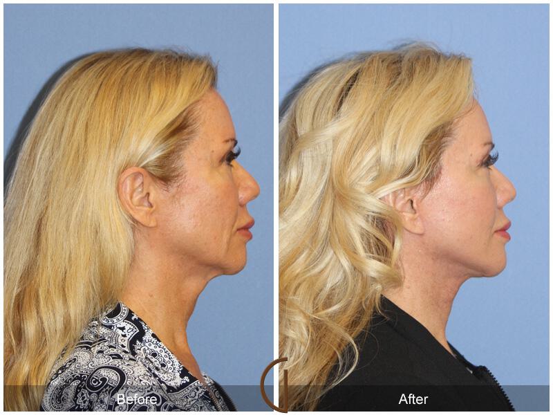 Facelift Fifties Before & After Photo